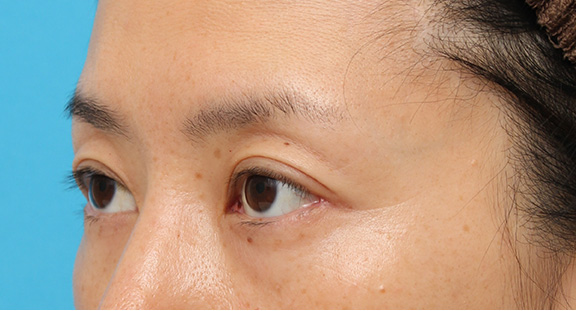 目尻切開,目尻切開で目を外側に広げた40代後半の女性の症例写真,After（6ヶ月後）,ba_mejiri016_b02.jpg