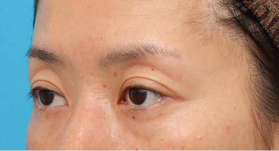 目尻切開,目尻切開で目を外側に広げた40代後半の女性の症例写真,Before,ba_mejiri016_b02.jpg