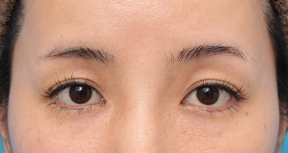 垂れ目（パンダ目）形成（グラマラスライン／下眼瞼下制術）,下三白眼にタレ目形成（グラマラスライン）を行った症例写真,After（9ヶ月後）,ba_panda020_a01.jpg