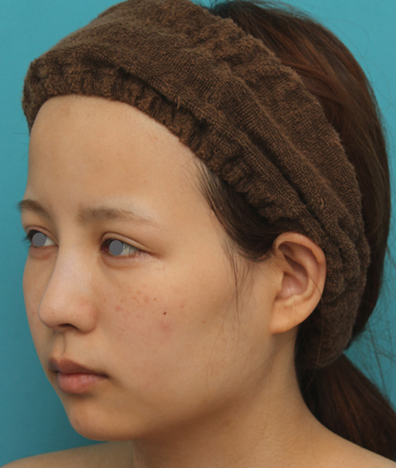 症例写真,顎にシリコンプロテーゼを入れ、Eラインを整えた20代女性の症例写真,After（6ヶ月後）,ba_ago014_b02.jpg