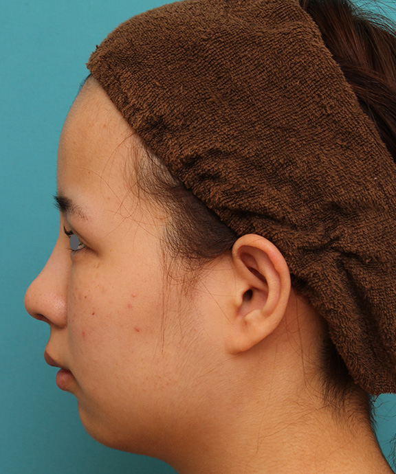 あご形成（シリコンプロテーゼ）,顎にシリコンプロテーゼを入れ、Eラインを整えた20代女性の症例写真,Before,ba_ago014_b03.jpg