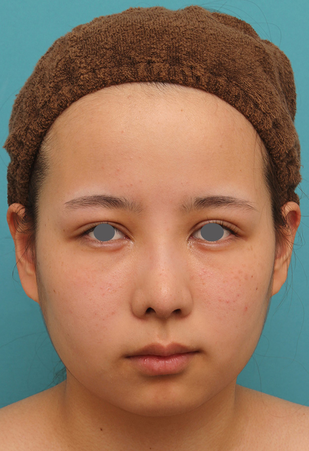 あご形成（シリコンプロテーゼ）,顎にシリコンプロテーゼを入れ、Eラインを整えた20代女性の症例写真,手術前,mainpic_ago014a.jpg
