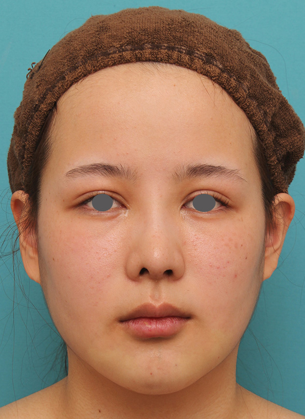 あご形成（シリコンプロテーゼ）,顎にシリコンプロテーゼを入れ、Eラインを整えた20代女性の症例写真,手術直後,mainpic_ago014b.jpg