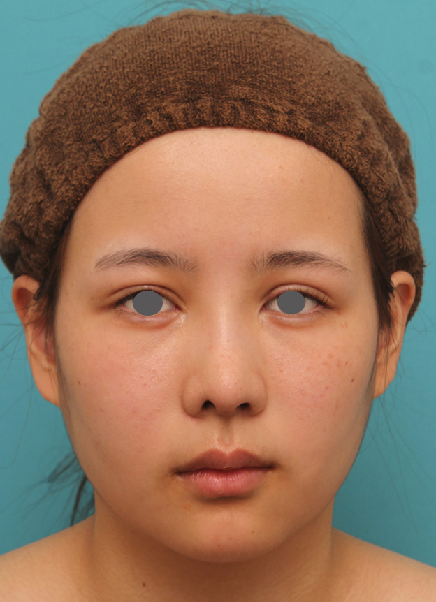 あご形成（シリコンプロテーゼ）,顎にシリコンプロテーゼを入れ、Eラインを整えた20代女性の症例写真,1週間後,mainpic_ago014c.jpg