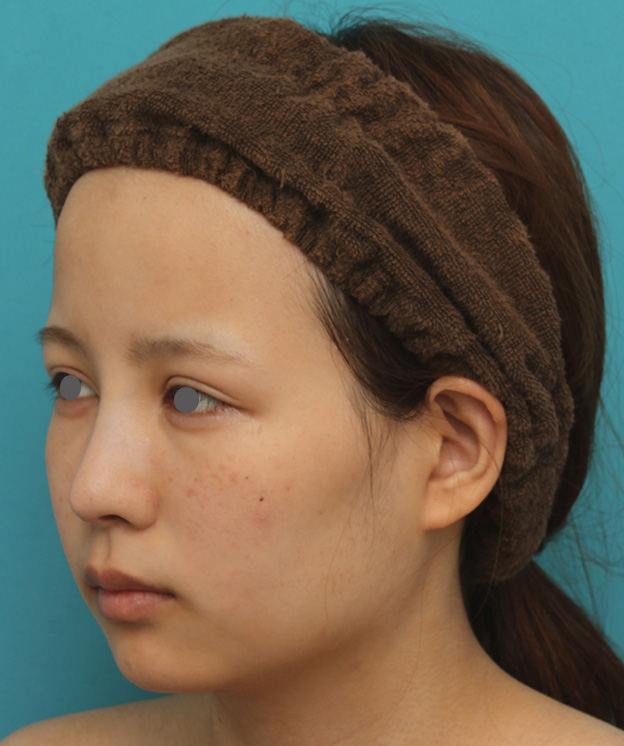 あご形成（シリコンプロテーゼ）,顎にシリコンプロテーゼを入れ、Eラインを整えた20代女性の症例写真,6ヶ月後,mainpic_ago014l.jpg