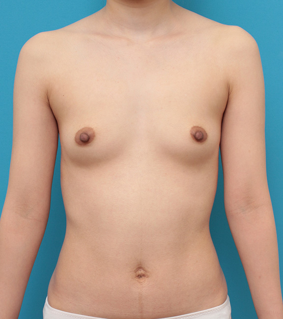 脂肪吸引,ピュアコンデンス脂肪注入豊胸,痩せている女性の太もも、お尻から脂肪吸引し、バストに脂肪注入豊胸した症例写真,Before,ba_shibokyuin032_b01.jpg