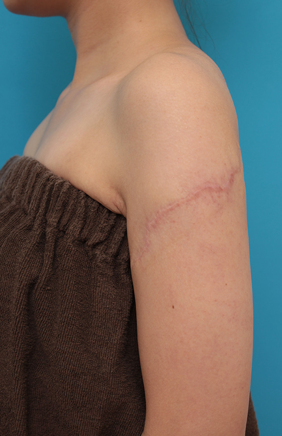 刺青（タトゥー）除去,レーザー治療の効果が乏しかった肩の大きな入れ墨を2回に分けて手術で切除した症例写真,After（2回目手術後1年）,ba_irezumi032_b01.jpg