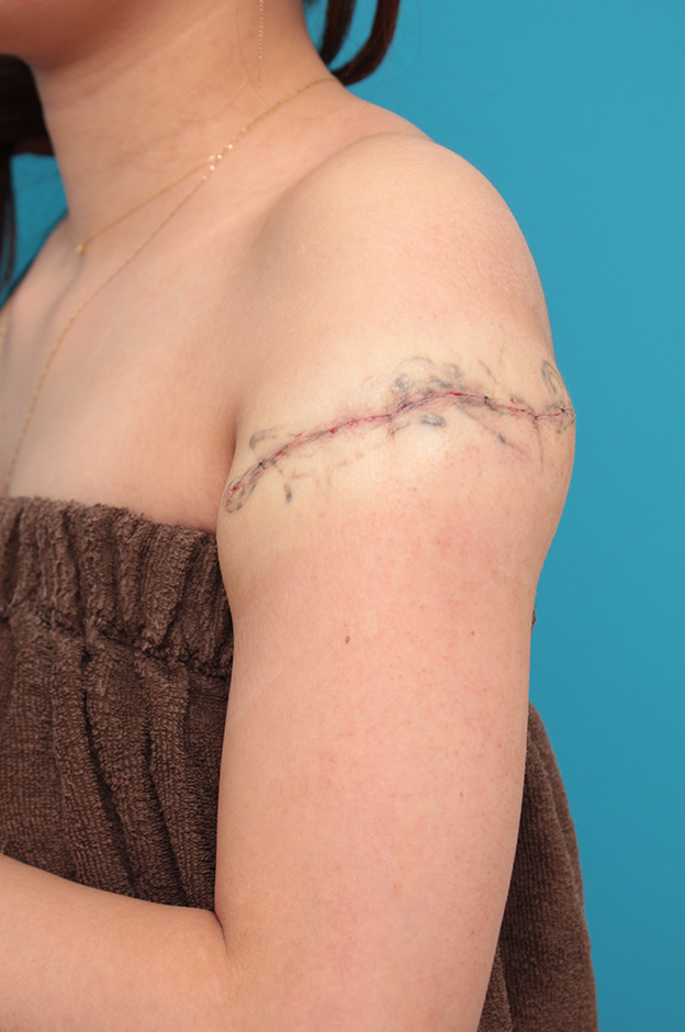 刺青（タトゥー）除去,レーザー治療の効果が乏しかった肩の大きな入れ墨を2回に分けて手術で切除した症例写真,1回目手術直後,mainpic_irezumi032b.jpg