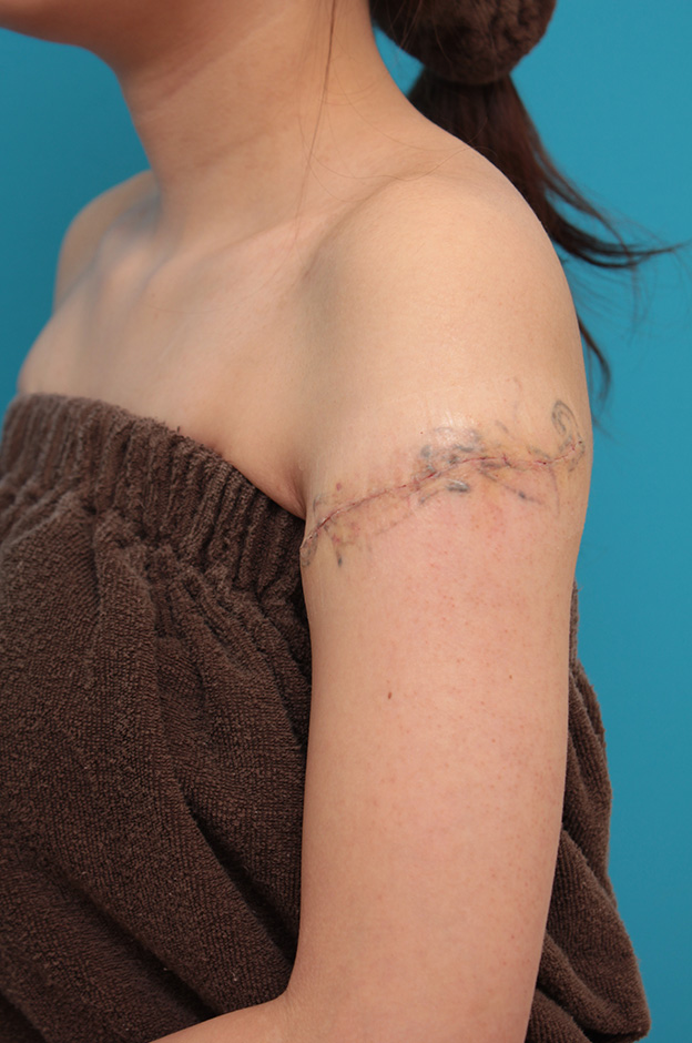 刺青（タトゥー）除去,レーザー治療の効果が乏しかった肩の大きな入れ墨を2回に分けて手術で切除した症例写真,1回目手術後1週間,mainpic_irezumi032c.jpg
