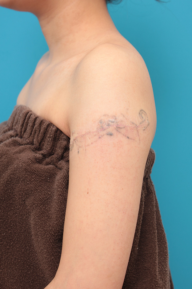 刺青（タトゥー）除去,レーザー治療の効果が乏しかった肩の大きな入れ墨を2回に分けて手術で切除した症例写真,1回目手術後1ヶ月,mainpic_irezumi032d.jpg