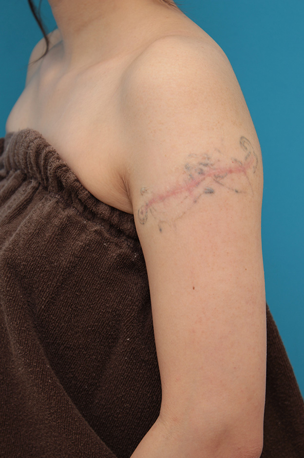 刺青（タトゥー）除去,レーザー治療の効果が乏しかった肩の大きな入れ墨を2回に分けて手術で切除した症例写真,1回目手術後6ヶ月,mainpic_irezumi032f.jpg