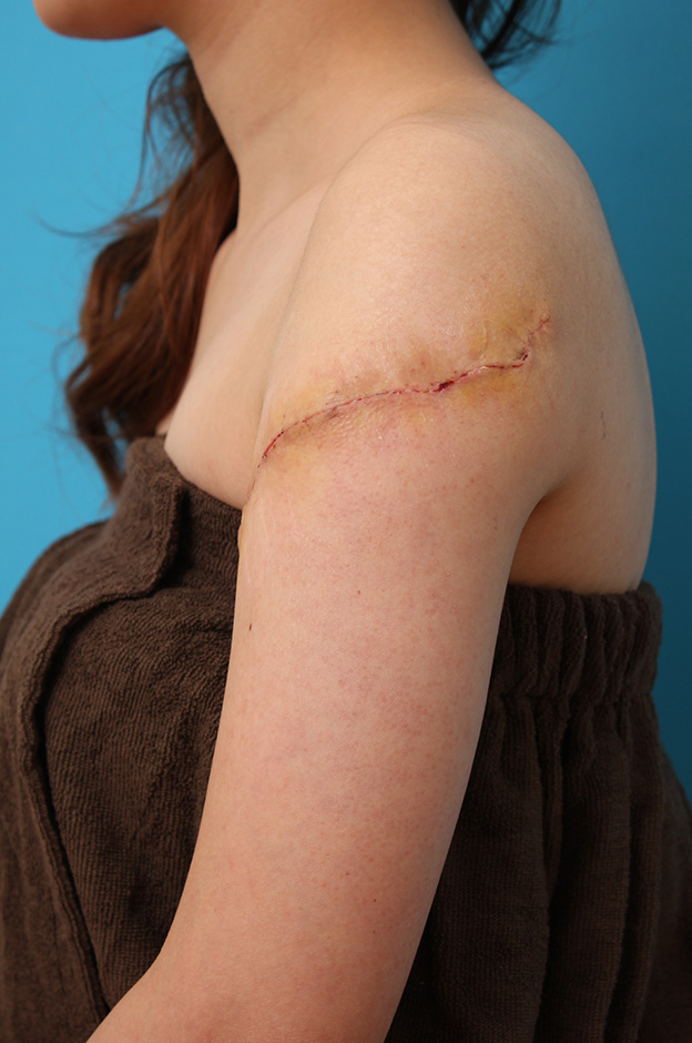 刺青（タトゥー）除去,レーザー治療の効果が乏しかった肩の大きな入れ墨を2回に分けて手術で切除した症例写真,2回目手術後1週間,mainpic_irezumi032h.jpg