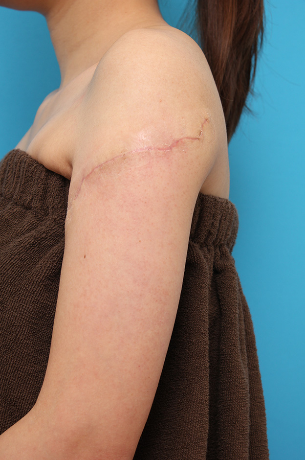 刺青（タトゥー）除去,レーザー治療の効果が乏しかった肩の大きな入れ墨を2回に分けて手術で切除した症例写真,2回目手術後1ヶ月,mainpic_irezumi032i.jpg
