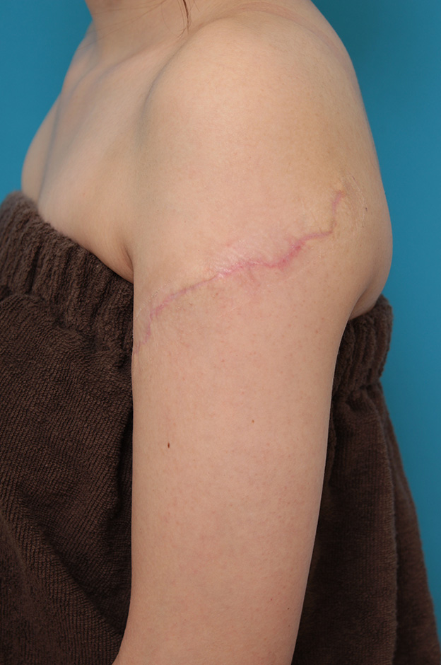 刺青（タトゥー）除去,レーザー治療の効果が乏しかった肩の大きな入れ墨を2回に分けて手術で切除した症例写真,2回目手術後3ヶ月,mainpic_irezumi032j.jpg