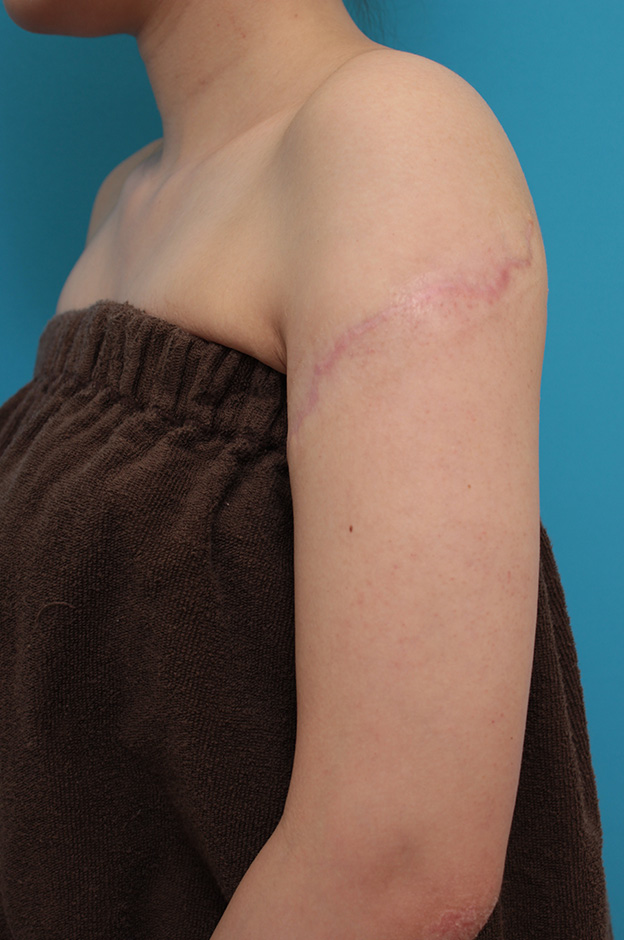 刺青（タトゥー）除去,レーザー治療の効果が乏しかった肩の大きな入れ墨を2回に分けて手術で切除した症例写真,2回目手術後6ヶ月,mainpic_irezumi032k.jpg