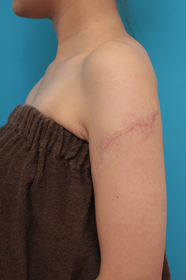 刺青（タトゥー）除去,レーザー治療の効果が乏しかった肩の大きな入れ墨を2回に分けて手術で切除した症例写真,2回目手術後1年,mainpic_irezumi032l.jpg