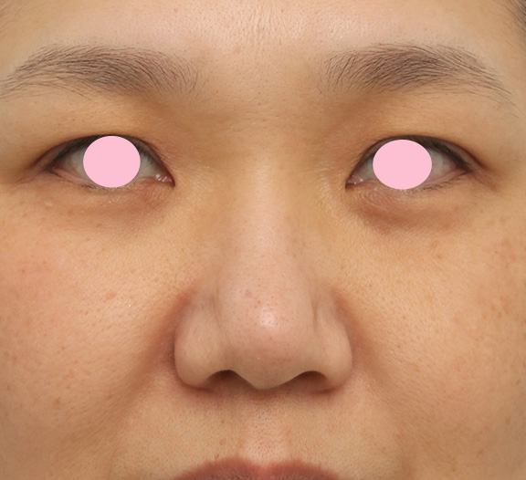 脂肪溶解注射メソシェイプフェイス（鼻先・小鼻）,団子鼻の鼻先と小鼻へのメソシェイプフェイス（脂肪溶解注射）の症例写真,Before,ba_meso_hanasaki001_b01.jpg