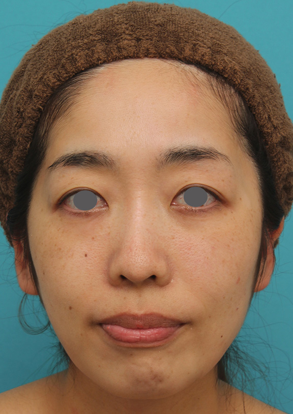 ウルセラシステムでたるみを引き締めて小顔になった30代前半女性の症例写真,After（3ヶ月後）,ba_ulthera020_a01.jpg