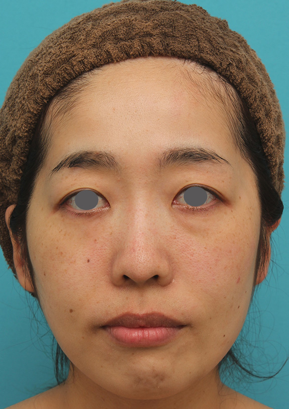 ウルセラシステムでたるみを引き締めて小顔になった30代前半女性の症例写真,Before,ba_ulthera020_b01.jpg