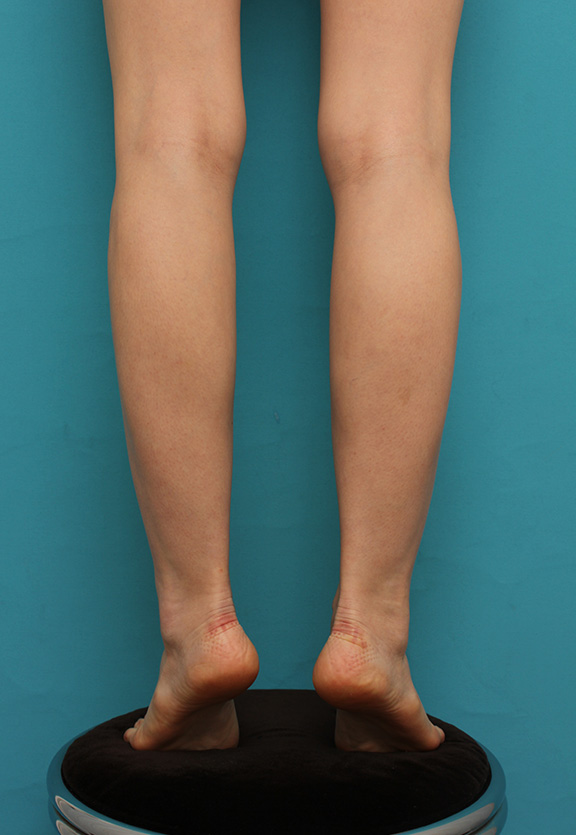 ボツリヌストキシン注射（ふくらはぎ・足やせ・美脚）,細い脚にボツリヌストキシン注射（ふくらはぎ・足やせ・美脚）を行い、更に細くした症例写真,After（注射後2ヶ月）,ba_leg009_b02.jpg