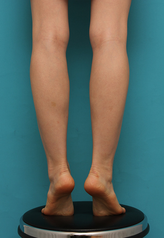 ボツリヌストキシン注射（ふくらはぎ・足やせ・美脚）,細い脚にボツリヌストキシン注射（ふくらはぎ・足やせ・美脚）を行い、更に細くした症例写真,Before,ba_leg009_b02.jpg