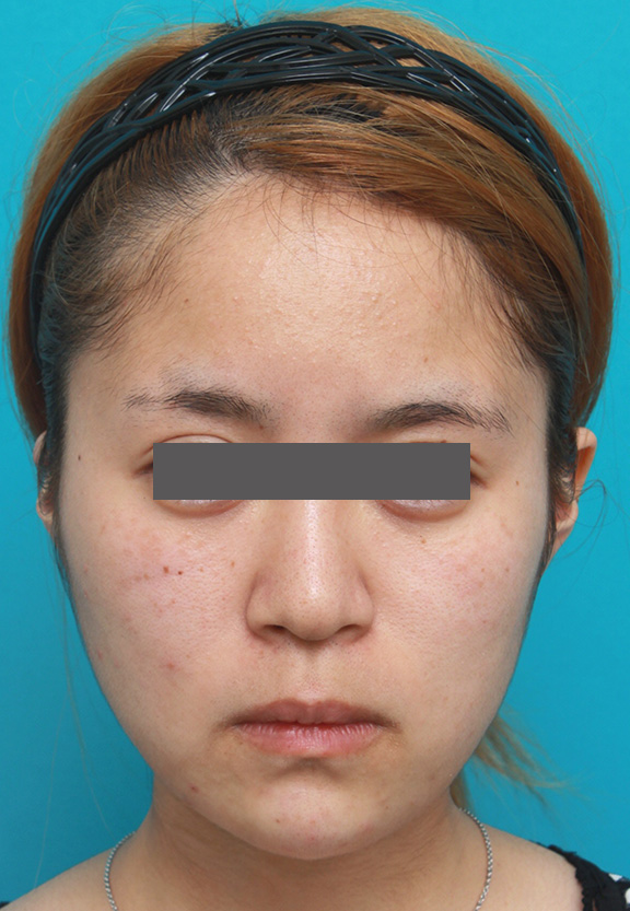 あご注射（ヒアルロン酸）,顎のヒアルロン酸注射でシャープなフェイスラインにした症例写真,After（注射直後）,ba_agochu011_b01.jpg