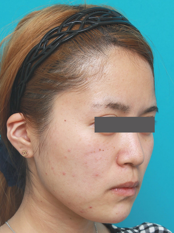 あご注射（ヒアルロン酸）,顎のヒアルロン酸注射でシャープなフェイスラインにした症例写真,After（注射直後）,ba_agochu011_b02.jpg