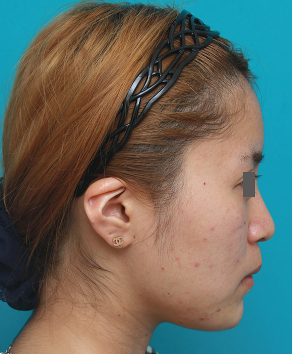 あご注射（ヒアルロン酸）,顎のヒアルロン酸注射でシャープなフェイスラインにした症例写真,After（注射直後）,ba_agochu011_b03.jpg