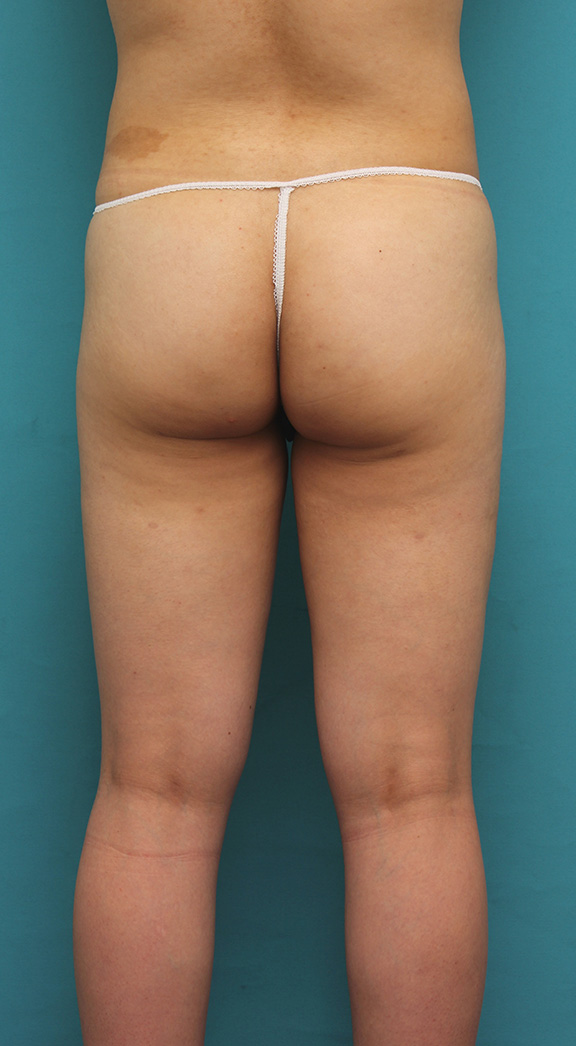 脂肪吸引,20代女性のお尻と太もも全体の脂肪吸引をした症例写真,After（6ヶ月後）,ba_shibokyuin033_b02.jpg