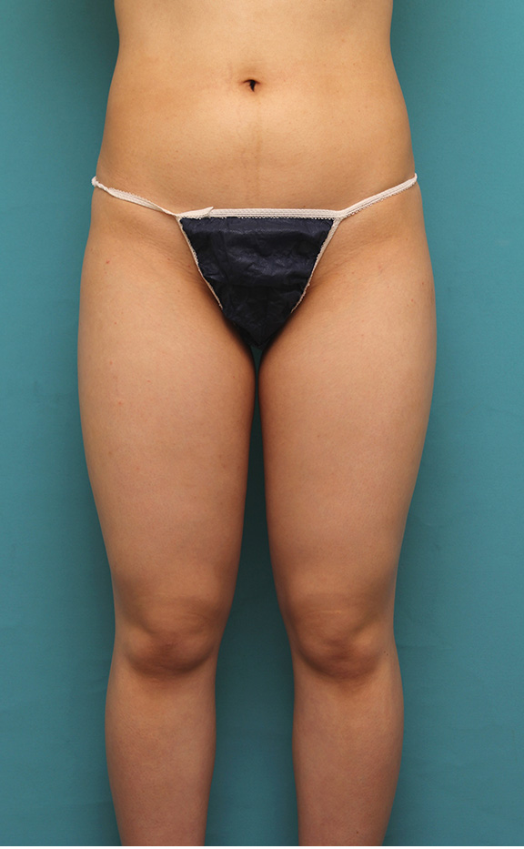 症例写真,20代女性のお尻と太もも全体の脂肪吸引をした症例写真,Before,ba_shibokyuin033_b01.jpg