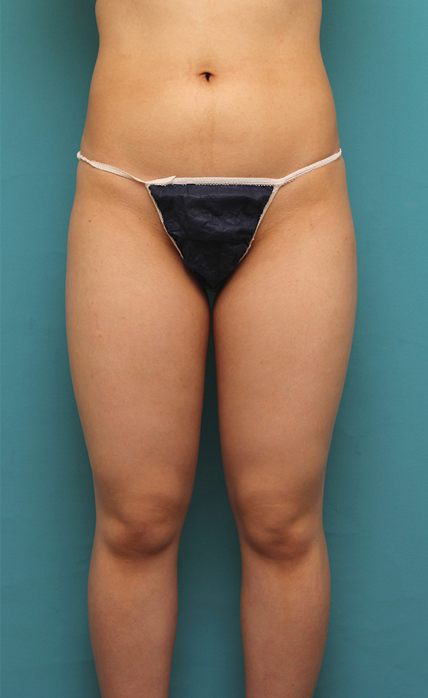 脂肪吸引,20代女性のお尻と太もも全体の脂肪吸引をした症例写真,手術前,mainpic_shibokyuin033a.jpg