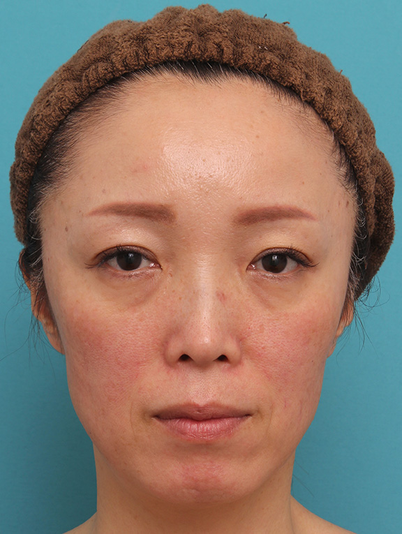 ヒアルロン酸チークヒアル（ヒアルロン酸で頬やこめかみをふっくら）,頬が痩けている女性にチークヒアルで肌の張りを出した症例写真,Before,ba_cheek001_b01.jpg