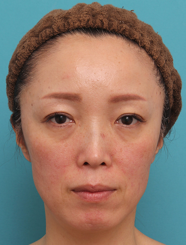ヒアルロン酸チークヒアル（ヒアルロン酸で頬やこめかみをふっくら）,頬が痩けている女性にチークヒアルで肌の張りを出した症例写真,治療前,mainpic_cheek001a.jpg