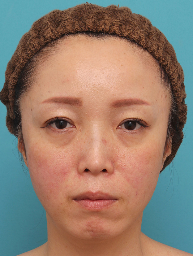 ヒアルロン酸チークヒアル（ヒアルロン酸で頬やこめかみをふっくら）,頬が痩けている女性にチークヒアルで肌の張りを出した症例写真,注射直後,mainpic_cheek001b.jpg