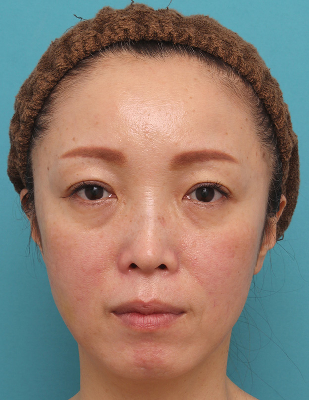 ヒアルロン酸チークヒアル（ヒアルロン酸で頬やこめかみをふっくら）,頬が痩けている女性にチークヒアルで肌の張りを出した症例写真,1週間後,mainpic_cheek001c.jpg