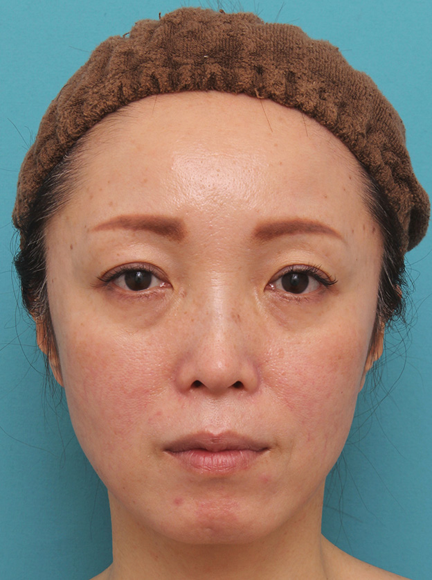 ヒアルロン酸チークヒアル（ヒアルロン酸で頬やこめかみをふっくら）,頬が痩けている女性にチークヒアルで肌の張りを出した症例写真,1ヶ月後,mainpic_cheek001d.jpg