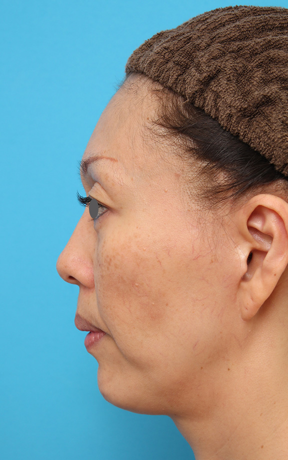 あご形成（シリコンプロテーゼ）,40代後半女性の引っ込んでいる顎にシリコンプロテーゼを入れた症例写真,After（6ヶ月後）,ba_ago016_b02.jpg