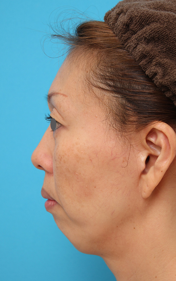 あご形成（シリコンプロテーゼ）,40代後半女性の引っ込んでいる顎にシリコンプロテーゼを入れた症例写真,Before,ba_ago016_b02.jpg