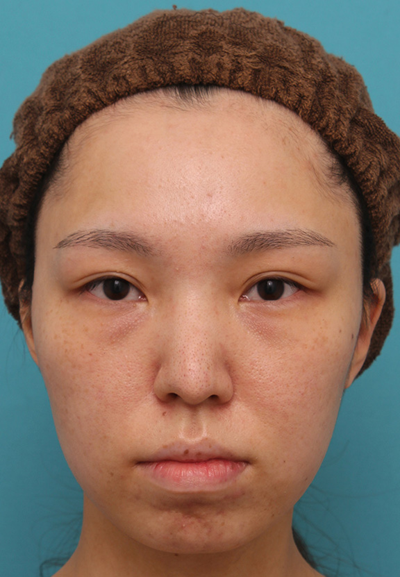 鼻中隔延長（鼻先を大きく下方に延ばす）,鼻中隔延長で鼻先を斜め下方向に出した症例写真,After（6ヶ月後）,ba_bichukaku002_a01.jpg