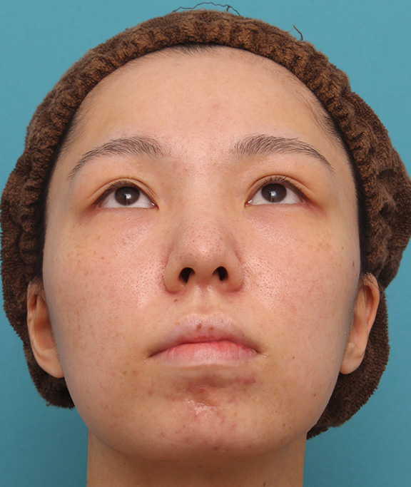 症例写真,鼻中隔延長で鼻先を斜め下方向に出した症例写真,After（6ヶ月後）,ba_bichukaku002_b04.jpg