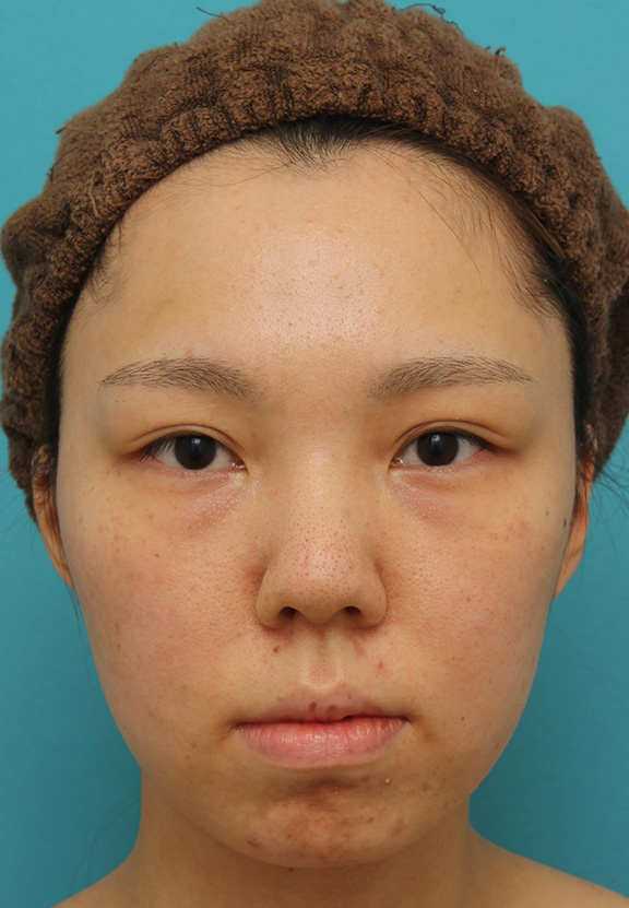 鼻中隔延長（鼻先を大きく下方に延ばす）,鼻中隔延長で鼻先を斜め下方向に出した症例写真,Before,ba_bichukaku002_b01.jpg