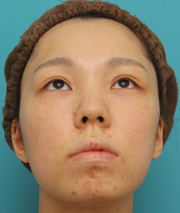 鼻中隔延長（鼻先を大きく下方に延ばす）,鼻中隔延長で鼻先を斜め下方向に出した症例写真,Before,ba_bichukaku002_b04.jpg