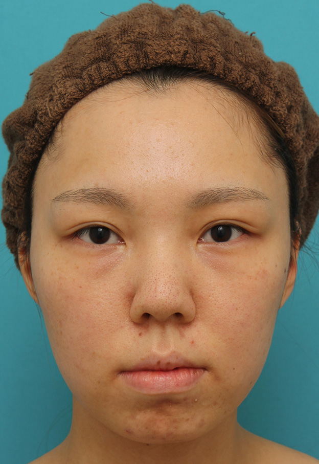 鼻中隔延長（鼻先を大きく下方に延ばす）,鼻中隔延長で鼻先を斜め下方向に出した症例写真,手術前,mainpic_bichukaku002a.jpg