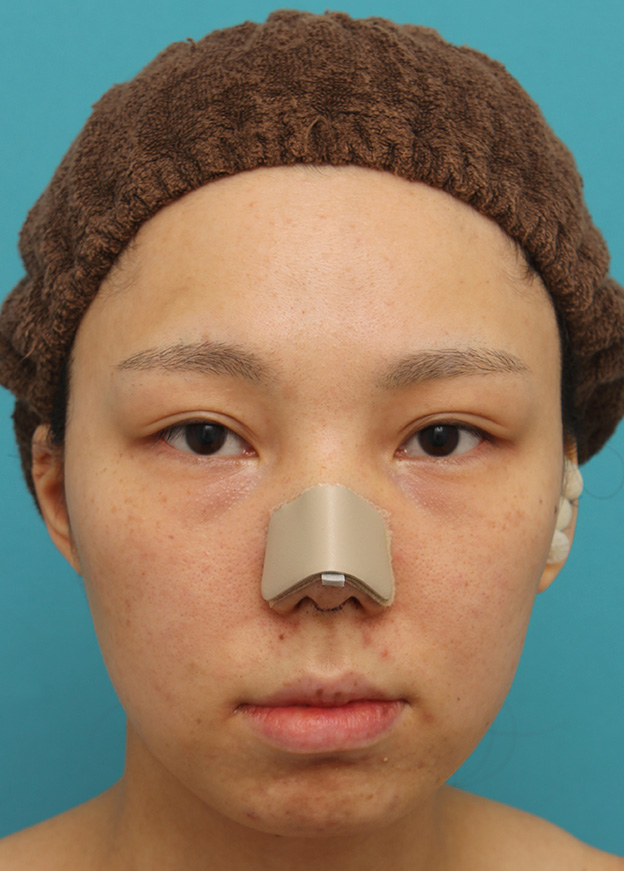 鼻中隔延長（鼻先を大きく下方に延ばす）,鼻中隔延長で鼻先を斜め下方向に出した症例写真,手術直後,mainpic_bichukaku002b.jpg
