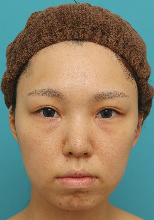 鼻中隔延長（鼻先を大きく下方に延ばす）,鼻中隔延長で鼻先を斜め下方向に出した症例写真,1週間後,mainpic_bichukaku002c.jpg