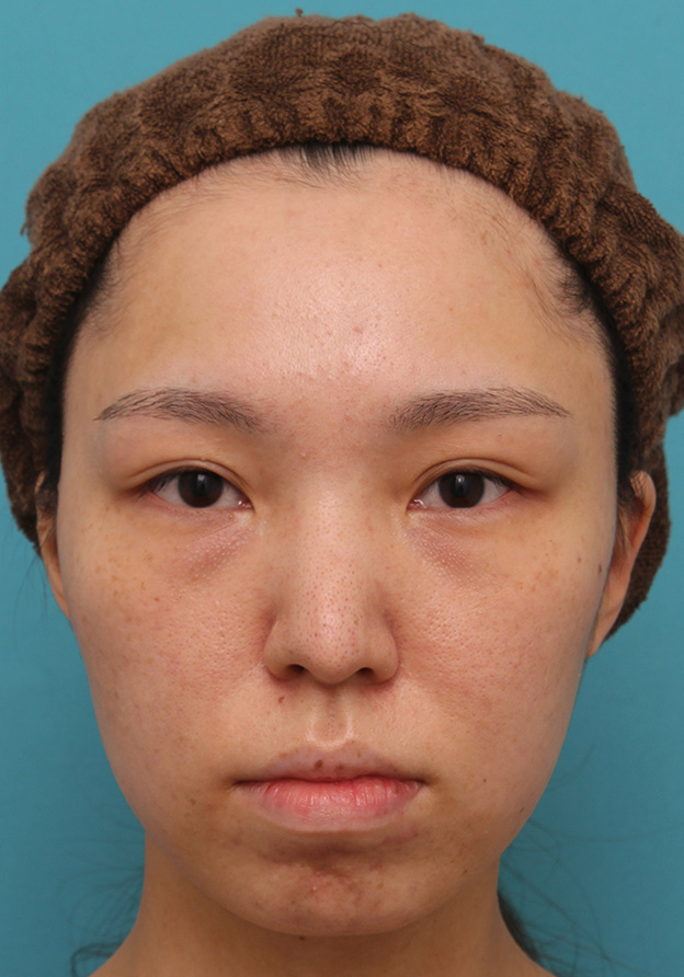 鼻中隔延長（鼻先を大きく下方に延ばす）,鼻中隔延長で鼻先を斜め下方向に出した症例写真,6ヶ月後,mainpic_bichukaku002d.jpg