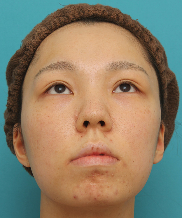 鼻中隔延長（鼻先を大きく下方に延ばす）,鼻中隔延長で鼻先を斜め下方向に出した症例写真,手術前,mainpic_bichukaku002e.jpg