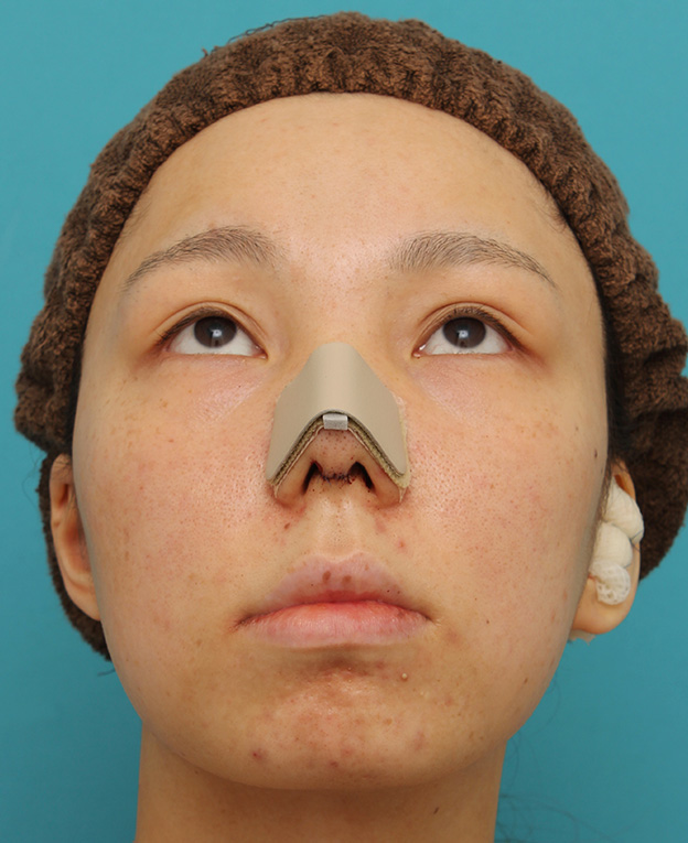 鼻中隔延長（鼻先を大きく下方に延ばす）,鼻中隔延長で鼻先を斜め下方向に出した症例写真,手術直後,mainpic_bichukaku002f.jpg