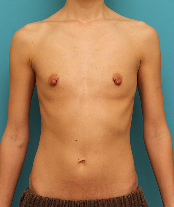 豊胸手術（シリコンプロテーゼ）,乳頭縮小,シリコンバッグプロテーゼ豊胸と乳頭縮小手術を同時に行った症例写真,Before,ba_hokyo026_b01.jpg