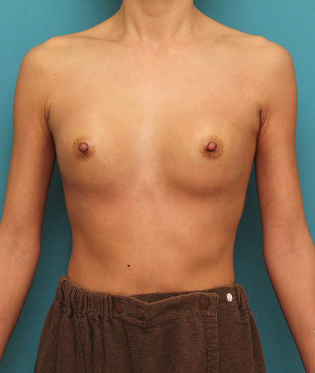 豊胸手術（シリコンプロテーゼ）,シリコンバッグプロテーゼ豊胸と乳頭縮小手術を同時に行った症例写真,手術直後,mainpic_hokyo026b.jpg